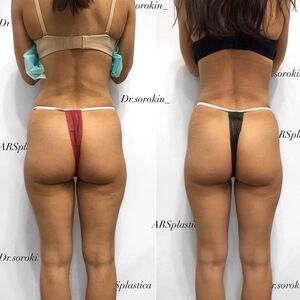 Как домашних условиях избавиться от целлюлита ?