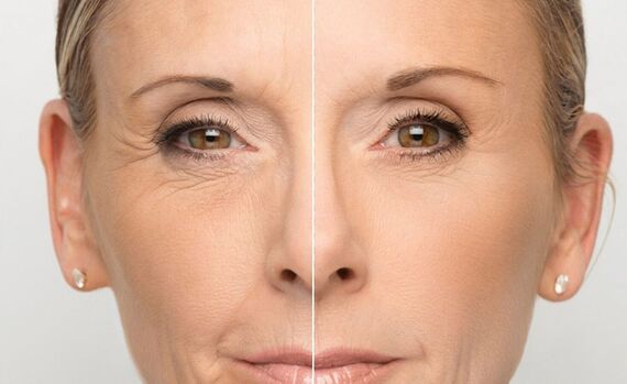 Гиалуроновая кислота и коллаген что лучше для здоровья кожи и суставов